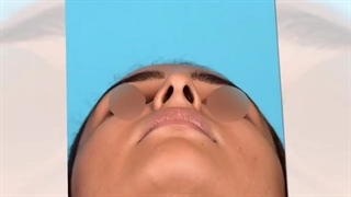 نتیجه جراحی بینی 2 ماه بعد