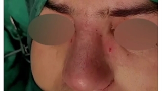 عمل بینی با غضروف گوش در بینی ترمیمی