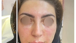 قبل و بعد ازتزریق فیلر خط خنده و زیر چشم