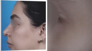 عمل لیفت آندوسکوپی ابرو و پیشانی