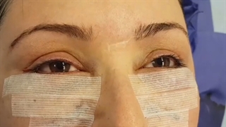 فیلم جراحی زیبایی پلک