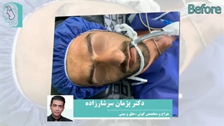 قبل و بعد جراحی زیبایی بینی