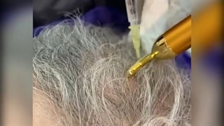 فیلم رضایت کاشت مو