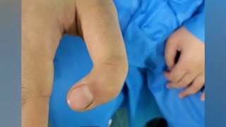 درمان دفرمیته انگشت دست