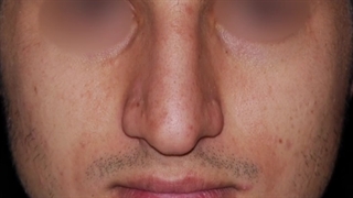 جراحی زیبایی بینی