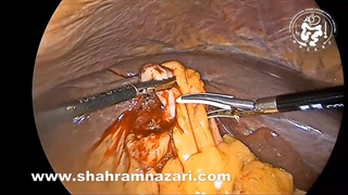 فیستول کیسه صفرا به روده بزرگ