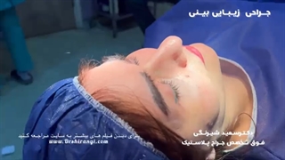 فیلم واقعی از عمل رینوپلاستی یا جراحی بینی