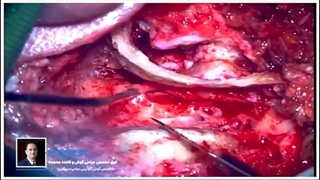 پیوند عصب صورت