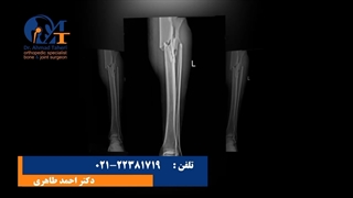 شکستگی ساق پا