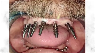 مراحل قالبگیری ۸ واحد ایمپلنت