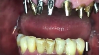 یکی از مراحل مهم درمان ایمپلنت، مرحله چک کردن نشست اباتمنت های ایمپلنت ها داخ