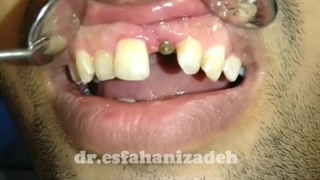 مراحل تحویل روکش فوری همزمان با جراحی ایمپلنت