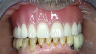 بازسازی فک بالای کاملا بی دندان با درمان اوردنچر متکی بر چهار ایمپلنت، همزمان با بازسازی نواحی خلفی فک پایین