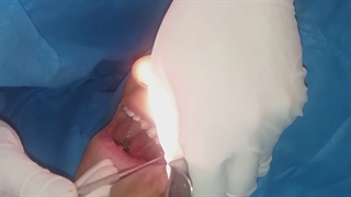 مراحل پیوند استخوان همراه با قرار دادن ایمپلنت