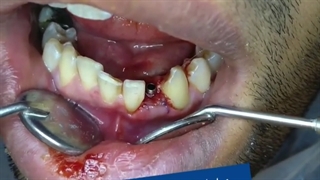 مراحل تحویل روکش موقت فوری همزمان با جراحی ایمپلنت