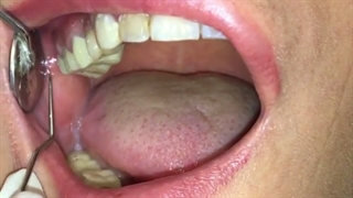 مشکلات روکش های رایج قسمت اول