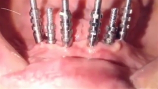 مراحل قالب گیری مستقیم از ۶ واحد ایمپلنت دندانی