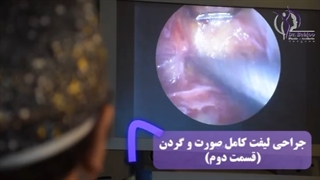 جراحی لیفت کامل صورت و گردن(بخش دوم)