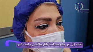تخلیه ژل زیر چشم همراه با بلفاروپلاستی و لیفت ابرو