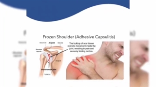 شانه یخ زده