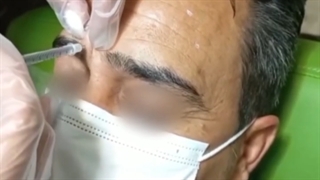 تزریق بوتاکس به پیشانی