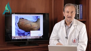 Phalloplasty of the Arm