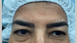عمل جراحی چهار پلک