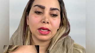 کاشت ابرو روی کلویید و اسکار