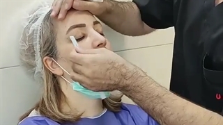 کانتوپلاستی جراحی پلک شرقی و نتیجه عمل کانتوپلاستی- کلینیک مارال