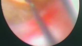 جراحی خورد کردن سنگ ( سنگ شکنی )