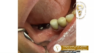 ⚜️پیوند لثه دو ایمپلنت ⚜️