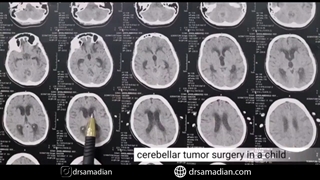 عمل جراحی تومور مخچه