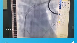 آنژیوپلاستی ورید اندام فوقانی