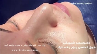 فیلم قبل و بعد از عمل زیبایی بینی دکتر سعید شیرنگی