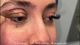 جراحی برداشتن خال کیسینگ