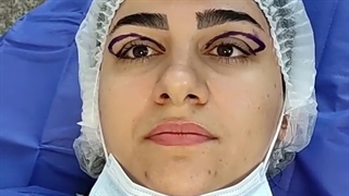 جراحی پلک توسط فوق تخصص پلاستیک دکتر نصیری-کلینیک vip تهران اینسایزینگ