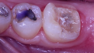 ترمیم دندان با پروتز آنله در چه مواقعی استفاده می‌شود؟ | کلینیک سیمادنت