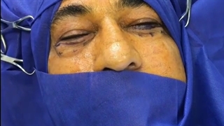 توضیحات بخیه پلک پایین توسط دکتر حسنلو-کلینیک vip تهران