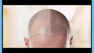 اصلاح طراحی خط رویش مو با کاشت مو