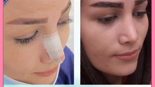 بهترین سن کاشت ابرو طبق نظر پزشکان متخصص