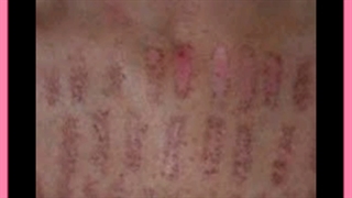 آیا لیزر باعث ایجاد زخم روی پوستمان می شود؟