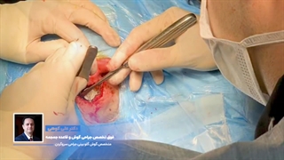 عمل جراحی کاشت سمعک استخوانی