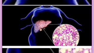 تاثیرات پاکسازی کبد در کاهش وزن + پیشنهاد بهترین مکمل دارویی و نکات مهم