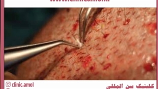 خونریزی بعد از کاشت مو