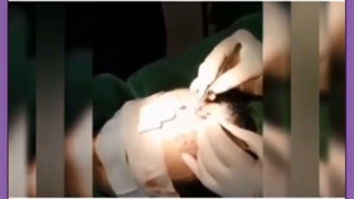 خونریزی بعد از کاشت مو