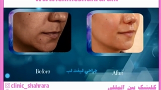 آشنایی با همه روش های لیفت لب به همراه عکس