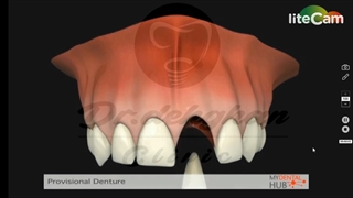 دکتر وحید دهقان : فلیپر چیست؟