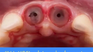 بهترین متخصص ایمپلنت دندان