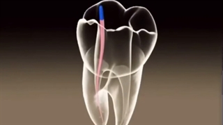 درمان ریشه دندان