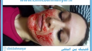 جوانسازی پوست با میکرونیدلینگ